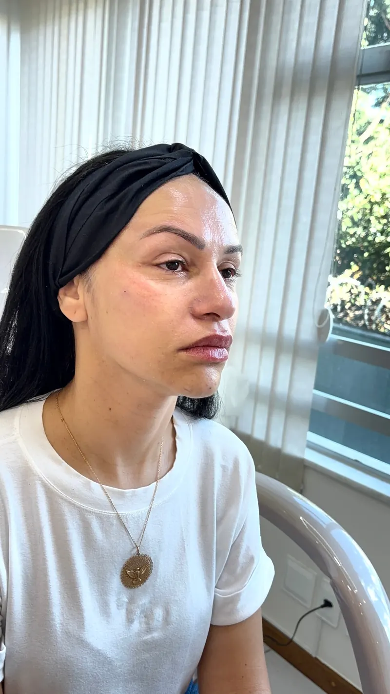 Paciente com contorno facial preservado após tratamento